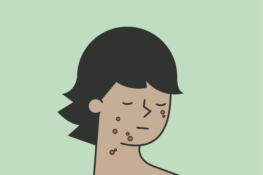 d_chicken pox