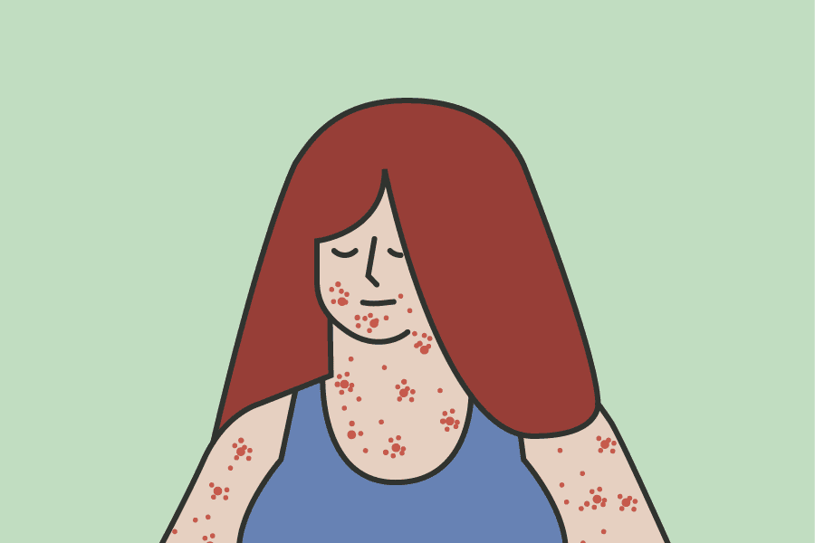 d_measles