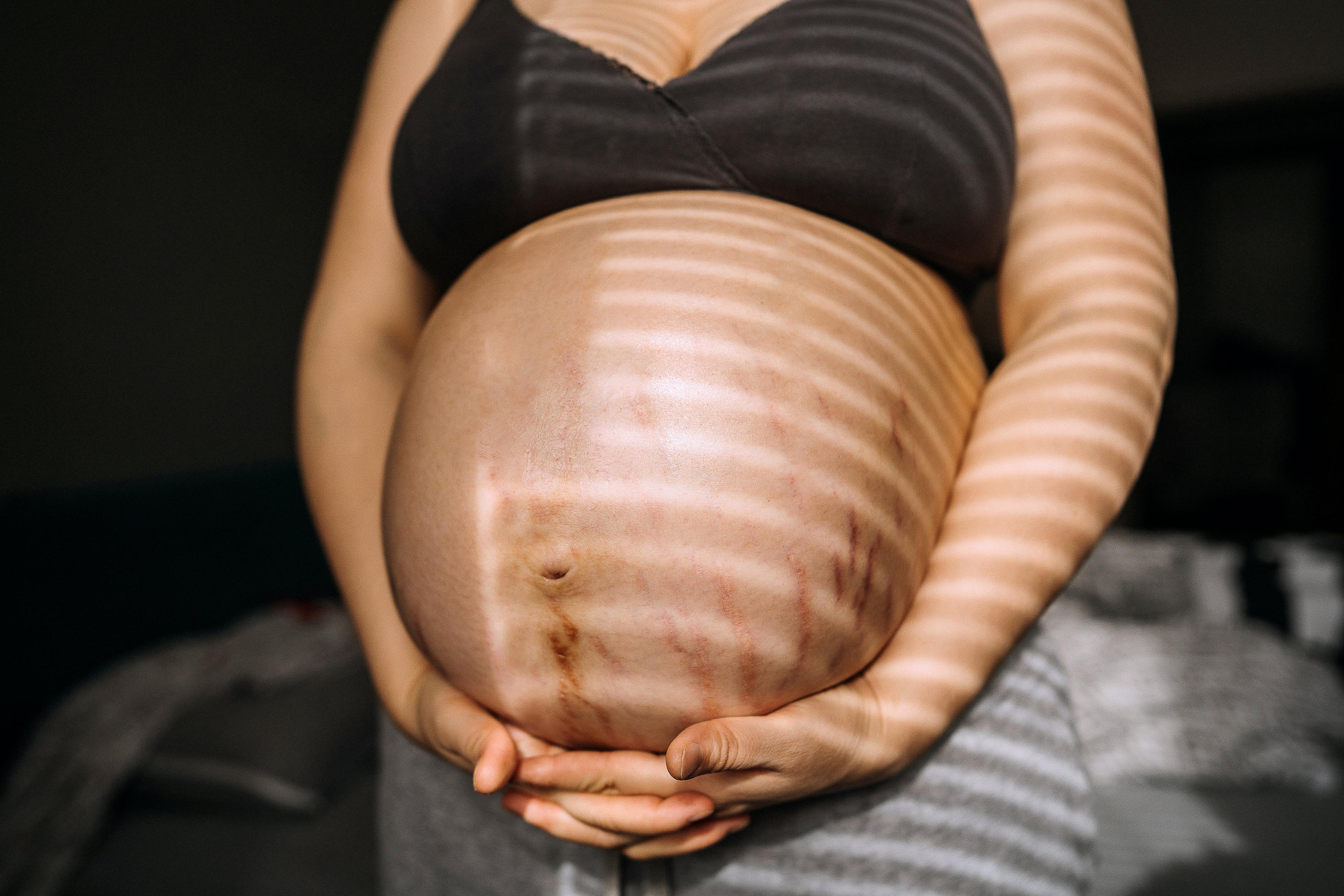 Brown pregnant woman with stretch marks